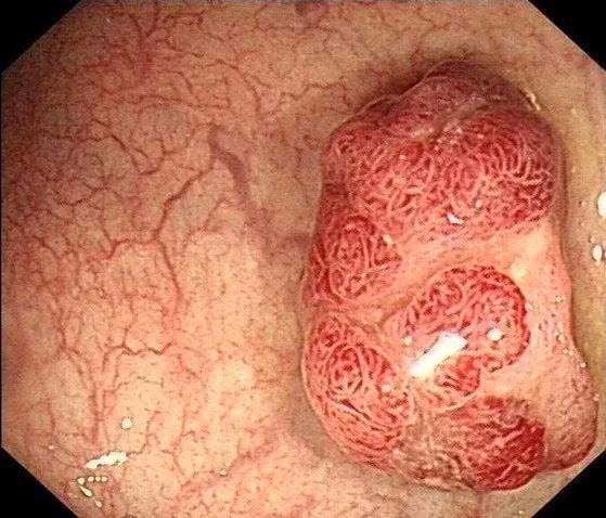Polyp đường ruột có phát triển thành ung thư ruột kết? Polyp duong ruot co phat trien thanh ung thu ruot ket?