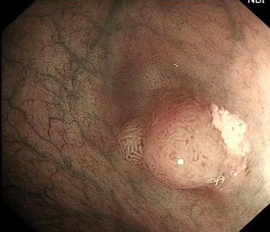 Polyp đường ruột có phát triển thành ung thư ruột kết? - Hình 3 Polyp duong ruot co phat trien thanh ung thu ruot ket?-Hinh-3