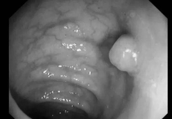 Polyp đường ruột có phát triển thành ung thư ruột kết? - Hình 4 Polyp duong ruot co phat trien thanh ung thu ruot ket?-Hinh-4