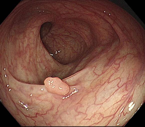 Polyp đường ruột có phát triển thành ung thư ruột kết? - Hình 2 Polyp duong ruot co phat trien thanh ung thu ruot ket?-Hinh-2