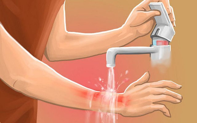 Sai lầm tai hại khi sơ cứu bỏng nhiều người vẫn tưởng là đúng Sai lam tai hai khi so cuu bong nhieu nguoi van tuong la dung