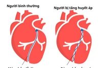 Đừng chủ quan với tăng huyết áp, hiểm họa không dấu hiệu