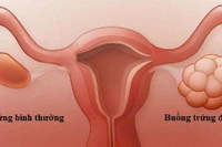 Buồng trứng đa nang, hiểm họa sức khỏe dễ bị bỏ qua