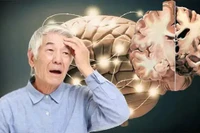 Cảnh giác với dấu hiệu sớm của Alzheimer