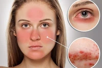 Nhận biết dấu hiệu lupus, phòng ngừa tổn thương nội tạng
