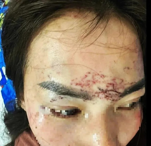 Bà M. bị đánh ghen thủng màng nhĩ, xăm lên mặt, đổ axit gây thương tích 8%.