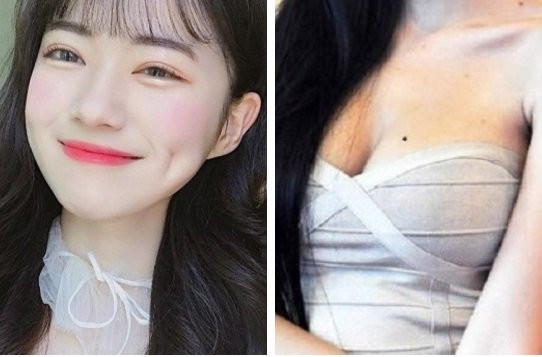 Nốt Ruồi Trước Ngực