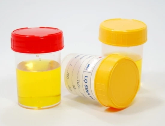 Nước tiểu có bọt: Dấu hiệu nguy hiểm của sức khỏe