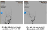 Trẻ 8 tuổi bị đột quỵ, cảnh báo bệnh ngày càng trẻ hoá