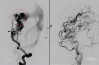 Bé gái 10 tuổi vượt qua 8 lần can thiệp mạch máu não 
