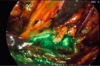 Ứng dụng kỹ thuật mới điều trị ung thư nội mạc tử cung