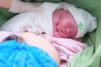 Giữ thai thành công sau khi bị hội chứng truyền máu song thai