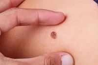 Dấu hiệu nhận biết ung thư da