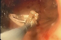 Cứu bé gái 6 tuổi nuốt kẹp tóc kim loại