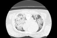 15 ngày giành sự sống cho nữ bệnh nhân 43 tuổi bị đuối nước mặn nguy kịch