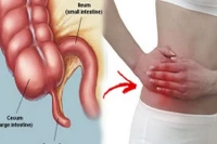 Chủ quan đau bụng kéo dài, người đàn ông 36 tuổi bị vỡ ruột thừa nguy kịch