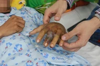 Cứu sống nam thanh niên 27 tuổi bị rắn chàm quạp cắn