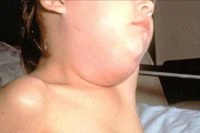 Nhận biết sớm dấu hiệu bệnh quai bị ở trẻ em giúp hạn chế biến chứng