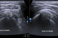 Đau vai cả tháng, người phụ nữ phát hiện viêm gân vôi hóa