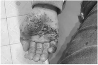 Trẻ 13 tuổi bị bỏng nặng do điện thoại phát nổ khi sạc