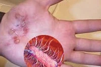 Điều trị thành công ca bệnh Whitmore tại Thái Nguyên