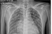 Cứu thành công ca tăng kali máu nguy kịch ở Nghệ An