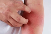 Số trẻ đến khám vì ban nhiễm trùng tăng cao