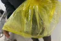 Con đỉa chui vào niệu đạo người đàn ông 75 tuổi
