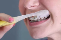 Cách chăm sóc răng miệng khi niềng răng