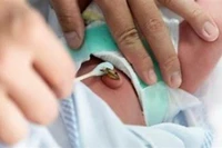 Bé trai 10 ngày tuổi nguy kịch do gia đình dùng kéo không vô trùng cắt rốn