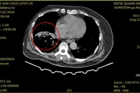 Người đàn ông ho ra máu nặng do giãn phế quản được cứu sống ngoạn mục