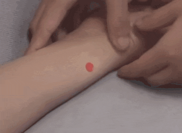 Hướng dẫn bấm huyệt, đắp thuốc chữa viêm bao gân tay 