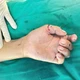 Bé trai 12 tuổi đứt lìa 2 ngón tay vì nghịch dao cắt cỏ