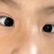Lạm dụng thiết bị điện tử khiến tình trạng mắt lác gia tăng