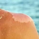 Phục hồi làn da tổn thương do cháy nắng