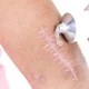 Thu hồi toàn quốc lô sản phẩm Gel Promed ngừa sẹo