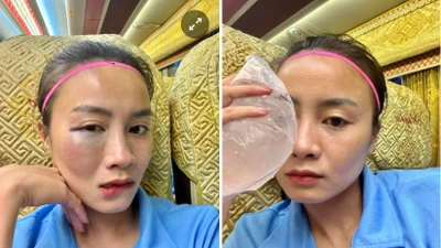 Fan xót xa trước gương mặt sưng vù của hot girl bóng đá Hoàng Thị Loan