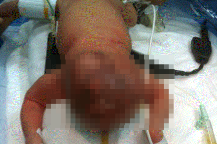 Khối u lớn ở vị trí hậu môn thai nhi được phẫu thuật thành công.