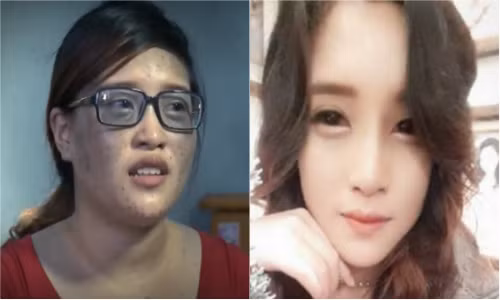Nữ sinh Hải Phòng mặt dính chàm lột xác xinh như mộng