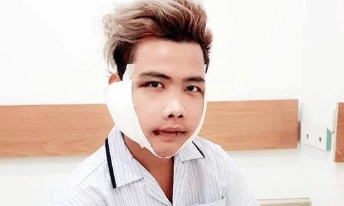 "Giật mình" trước nhan sắc của Tùng Sơn sau phẫu thuật thẩm mỹ