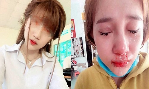 Cô gái bị bạn trai cũ đánh dập mũi vì không nghe lời?