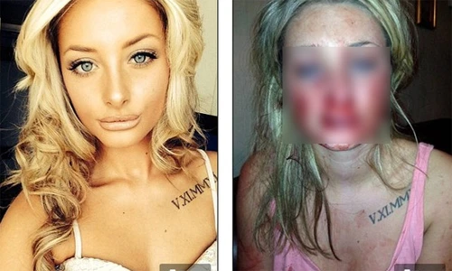 Gái xinh bị bạn trai máu “Hoạn Thư” cắn nát môi