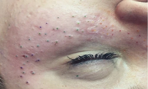 Mốt xăm tàn nhang đáng yêu trên mặt khiến phái đẹp thế giới điên đảo