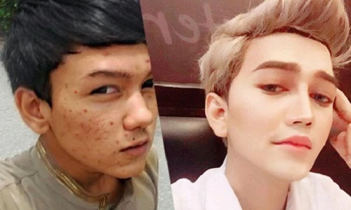 Khuôn mặt mụn khủng khiếp của hot boy Malaysia trước khi "dao kéo"
