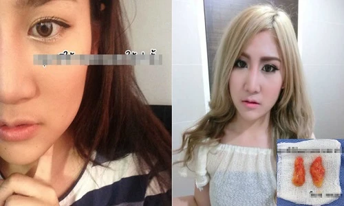 Gái xinh Thái Lan cắt thịt ở má làm cằm V-line