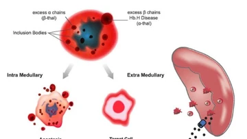 Phát hiện trẻ 19 tháng mắc đột biến gen Thalassemia từ dấu hiệu da nhợt, còi