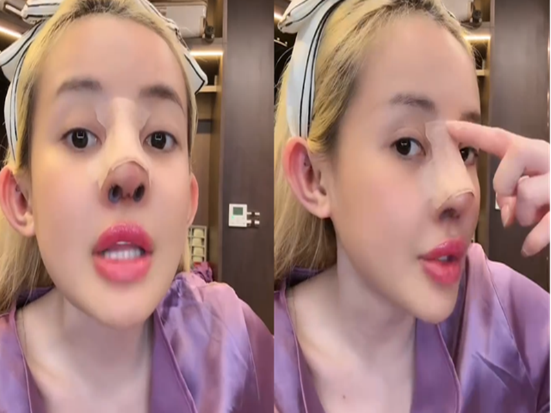 Ngân 98 từng gặp không ít biến chứng khi dao kéo mũi như sống mũi bị lệch, trụ mũi nghiêng sang một bên, có dịch viêm. Ảnh: Phụ Nữ Số.