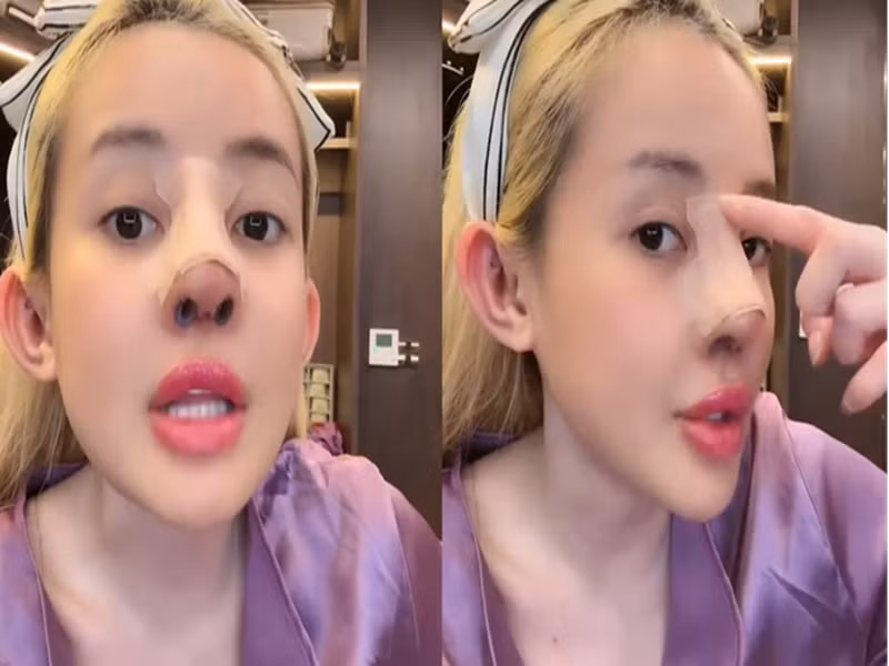 Ngân 98 từng gặp không ít biến chứng khi dao kéo mũi như sống mũi bị lệch, trụ mũi nghiêng sang một bên, có dịch viêm. Ảnh: Phụ Nữ Số.