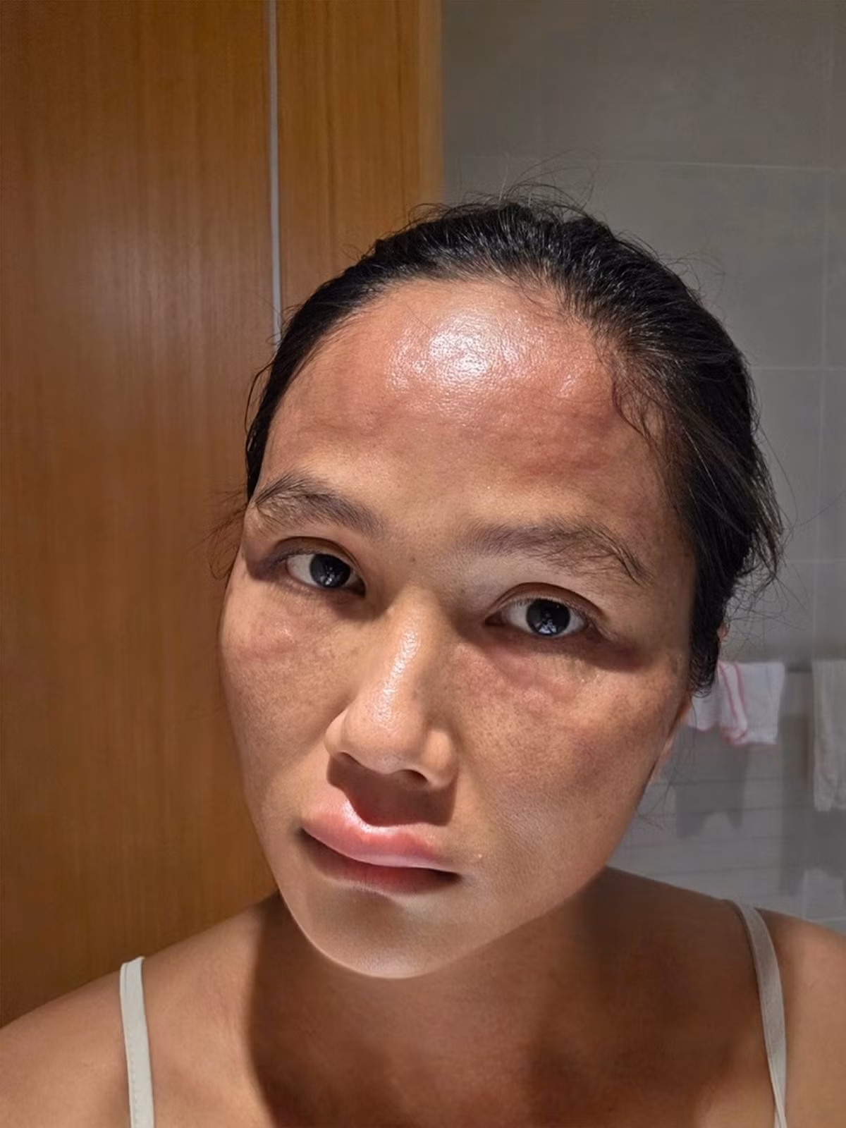 H'hen Niê cho biết, cứ mỗi buổi chiều, cô lại bị nổi mề đay. Sau 4 ngày, tình trạng ngứa, sưng của cô đã giảm dần. Ảnh: FB H'hen Niê.