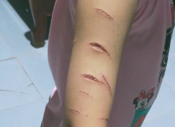 Vết thương trên tay em N.